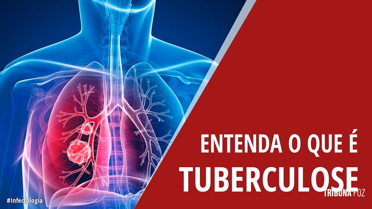 Brasil está na contramão da meta da OMS para extinção da tuberculose