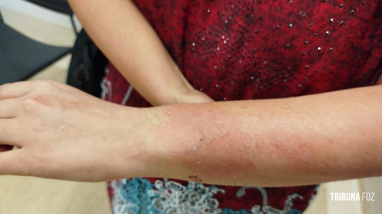 Violência doméstica: Mulher é atacada com água fervente e agressor é preso pela Guarda Municipal